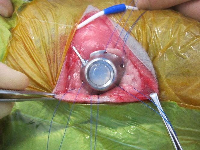A pleuraport being implanted 